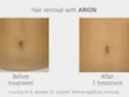 Thumbnail for rakeclal