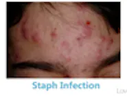 Thumbnail for surogeso